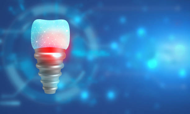 Changing the Game in Implant Dentistry