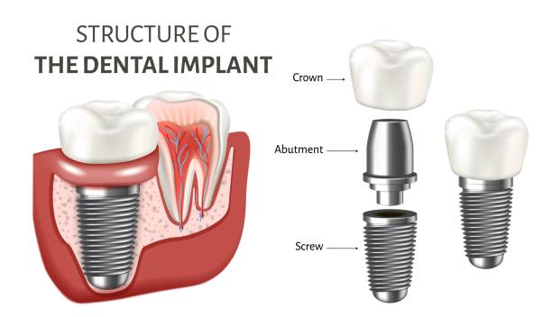 All-on-4 Dental Implants