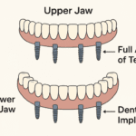All-on-4 Dental Implants