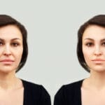 Fillers a Good Option