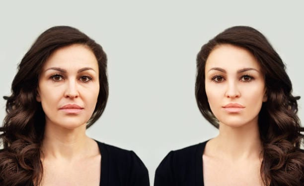 Fillers a Good Option